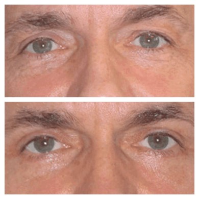 Before-after-eyelids-surgery