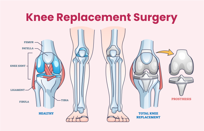 Knee-Replacement-Surgery