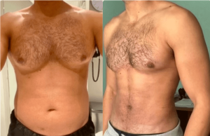 NPS_funderburk-before-after-male-hd-lipo-2.16-5-min