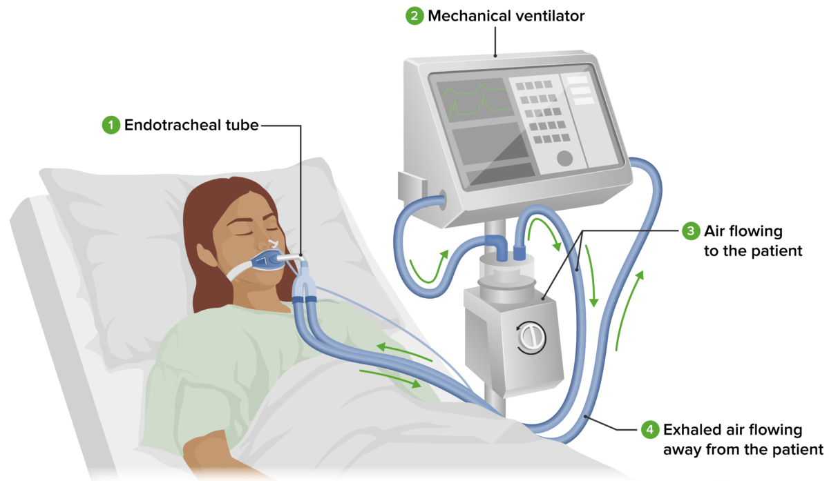 Mechanical Ventilation