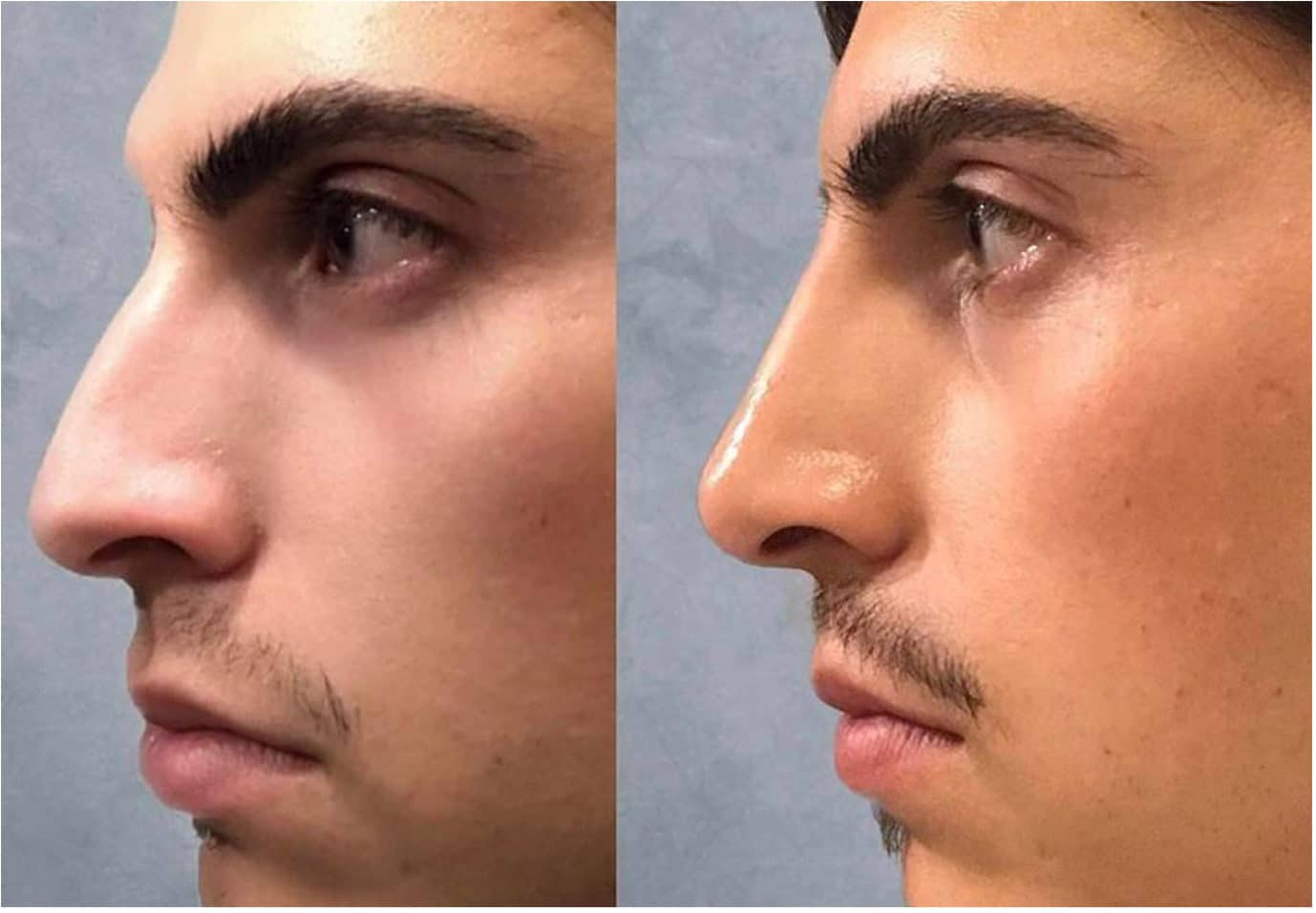 nose filler